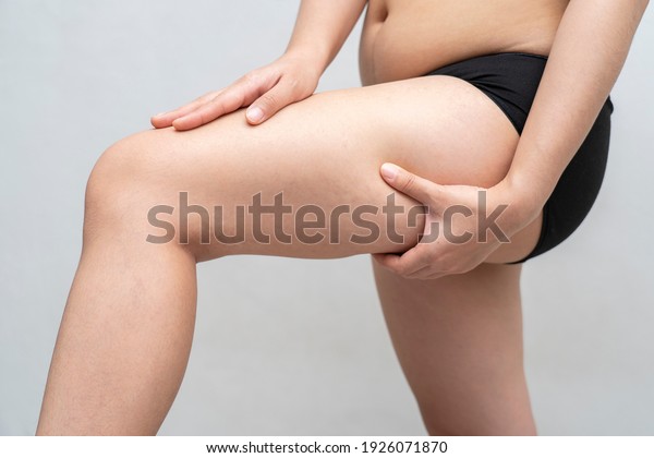Asian woman is\
testing the skin for stretch marks and cellulite or showing her\
cellulite. ,Cellulite skin on her legs. Surgery or health care,\
beauty and female concept