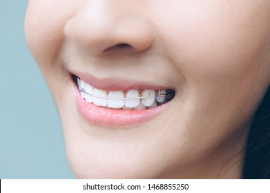 Asian Woman Wareing Orthodontic Retainers.Teeth Retaining Tools After Braces .