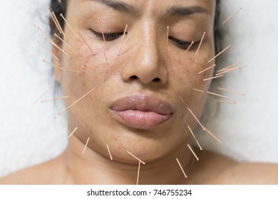 Asian women 40 years old acupuncture acupuncture on face to maintain health and skin to be healthy, firm skin.