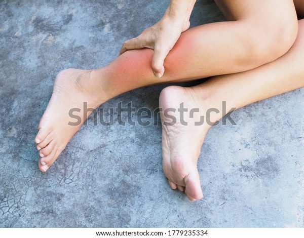Asian women suffering from leg pain swollen and\
inflamed legs or ankle\
sprain