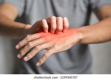 Asian Young Man Scratching His Hand. Concept Of Itchy Skin Diseases Such As Scabies, Fungal Infection, Eczema, Psoriasis, Rash, Allergy, Etc.