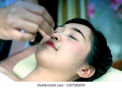 Asian young woman undergoing acupuncture treatment at the health spa; Traditional Chinese Medicine Acupuncture to treatment. healty concept
