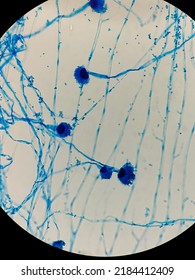 Aspergillus Fumigatus With Lpcb Stain