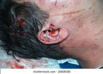 Assault Victim With A Stab Wound To The Right Ear.