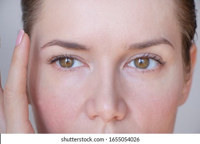 
Asymmetry Of The Face And Drooping Eyelid