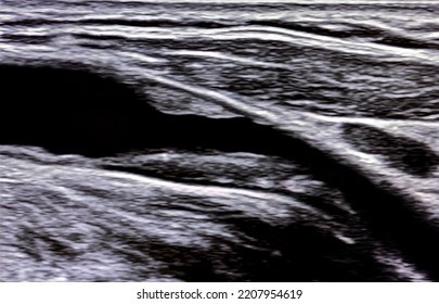 Atherosclerosis, Carotid Artery Stenosis. Ultrasound Image Of Atherosclerotic Plaque