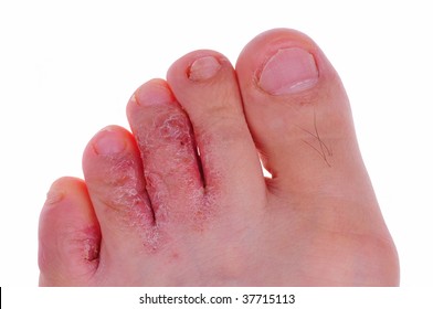 Athlete's Foot