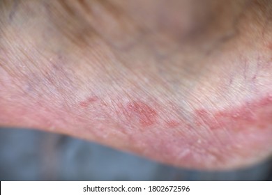 Athlete's foot, known medically as tinea pedis, on the left foot of a middle-aged man. The disease is a common skin infection of the feet caused by fungus.