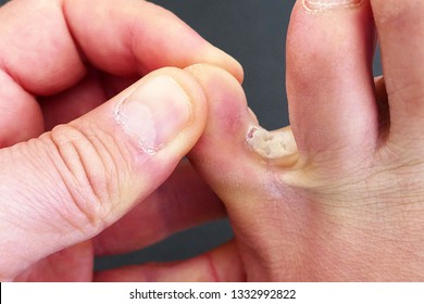 Athlete's Foot, Ringworm Between The Toes,