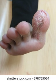 Athlete's Foot Or Tinea Pedis, Medical And Health Care