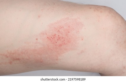 Atopic Dermatitis (AD) Inflammation Of The Skin. 
Allergy Atopic Eczema Toxic Leg Body. 