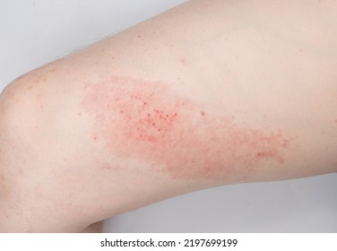 Atopic Dermatitis (AD) Inflammation Of The Skin. 
Allergy Atopic Eczema Toxic Leg Body. 