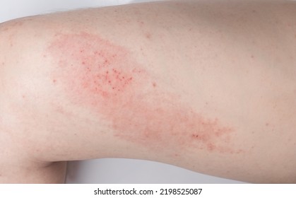 Atopic Dermatitis (AD) Inflammation Of The Skin. 
Allergy Atopic Eczema Toxic Leg Body. 