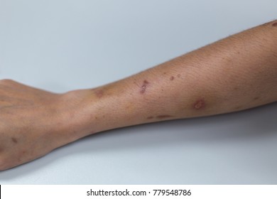 Scar Caused By Hemodialysis Renal Artery Stock Photo (Edit Now) 1014122437