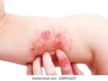 Atopic dermatitis (AD), also known as atopic eczema, is a type of inflammation of the skin (dermatitis) at foot.
 - Shutterstock ID 1039915537