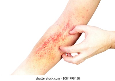 Atopic dermatitis (AD), also known as atopic eczema, is a type of inflammation of the skin (dermatitis) at foot. - Shutterstock ID 1084998458