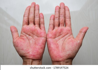 Eczema High Res Stock Images Shutterstock