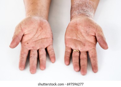 Atopic Dermatitis Ad Known Atopic Eczema Stock Photo (Edit Now) 697596277