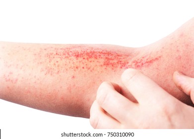 Atopic dermatitis (AD), also known as atopic eczema, is a type of inflammation of the skin (dermatitis) at foot. - Shutterstock ID 750310090