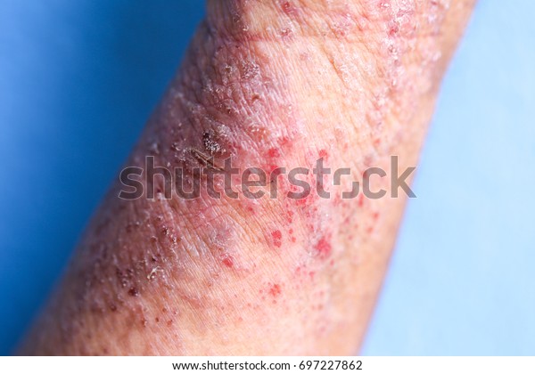 アトピー性皮膚炎 Ad は アトピー性湿疹とも呼ばれ 皮膚 皮膚炎 の炎症の一種である の写真素材 今すぐ編集