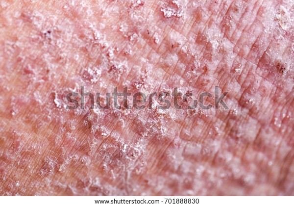 Atopic Dermatitis Ad Known Atopic Eczema Stock Photo 701888830 ...