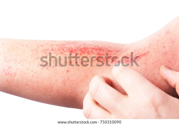アトピー性皮膚炎 Ad は アトピー性湿疹とも呼ばれ 足の皮膚 皮膚炎 の一種である の写真素材 今すぐ編集