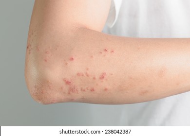 Atopic Dermatitis  ,  allergic to chemicals,Itchy skin lesions from allergies, skin women. - Shutterstock ID 238042387