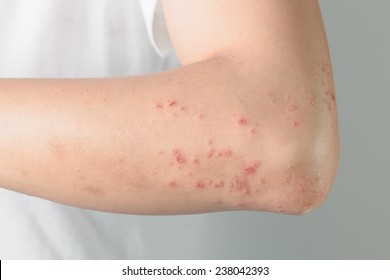 .Atopic Dermatitis  ,  allergic to chemicals,Itchy skin lesions from allergies, skin women.