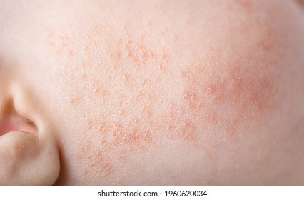 Atopic Dermatitis Allergy Rash Skin Problems On Baby Infant Cheek On Cheeks Macro Photo 