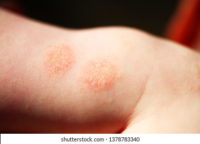 Atopic Dermatitis  Child