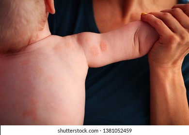 Atopic Dermatitis  Child Skin Problem