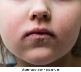 Atopic Dermatitis In Children.