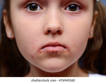 Atopic Dermatitis In Children