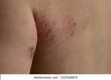 Razor bumps herpes Shaving bumps