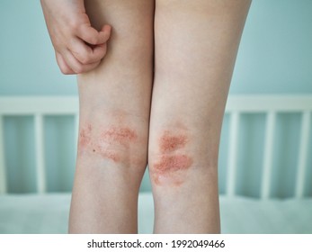 Atopic Dermatitis Close Up. Allergy Spots And Red Itchy Skin Inflammation On Child's Feet. Eczema On Kid's Legs