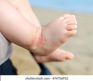 atopic dermatitis newborn feet eczema - Shutterstock ID 474756952