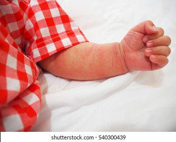 Atopic Dermatitis On Arm  In Baby