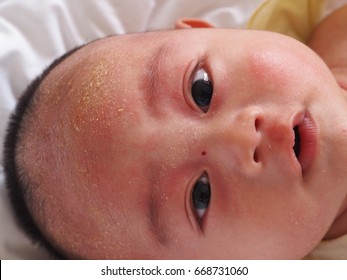 Atopic Dermatitis Seborrheic Dermatitis Baby Stock Photo 668731060 ...