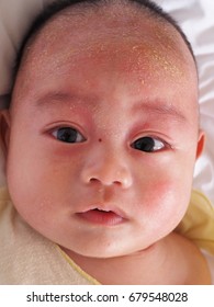 Atopic Dermatitis And Seborrheic Dermatitis In A Baby.

