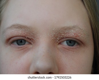 Atopic Dermatitis In The Stage Of Exacerbation On The Face And Eyelids Of A Teenage Girl