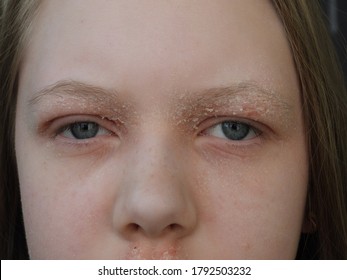 Atopic Dermatitis In The Stage Of Exacerbation On The Face And Eyelids Of A Teenage Girl