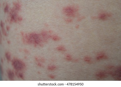 Atopic Dermatitis Symptom Skin Detail Texture Foto Stock Shutterstock