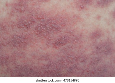 Atopic Dermatitis Symptom Skin Detail Texture