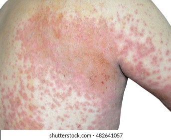  atopic dermatitis symptom skin detail texture