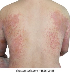 atopic dermatitis symptom skin detail texture