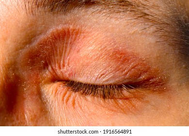 Atopic eczema around the eye