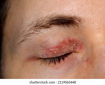 Atopic Eczema Around The Eye