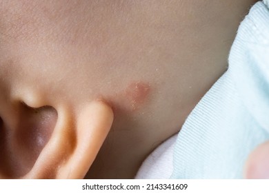 Atopic Eczema Dermatitis Skin Condition On Unknown Baby Close Up