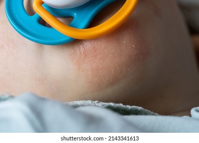 Atopic Eczema Dermatitis Skin Condition On Unknown Baby Chin Close Up