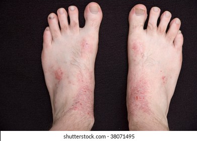 3,044 Eczema foot Images, Stock Photos & Vectors | Shutterstock